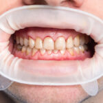 How to Get Rid of Dental Fluorosis
